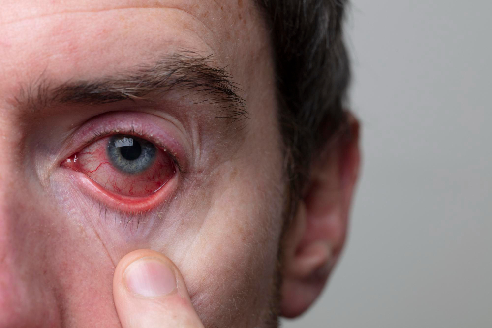 Pink Eye Treatment in Hyderabad