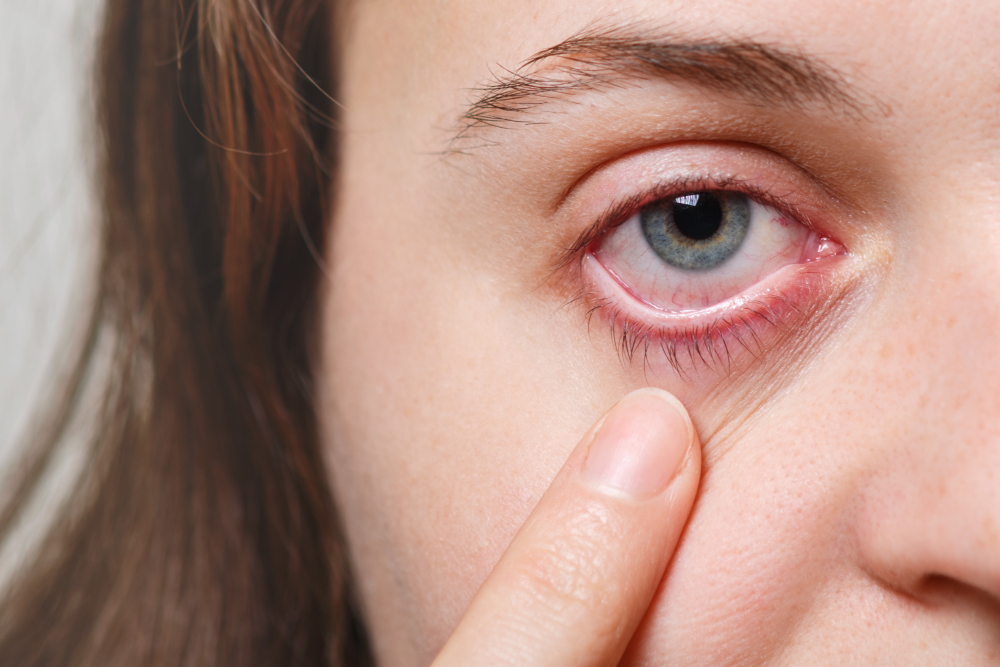 Dry Eye Treatment in Hyderabad