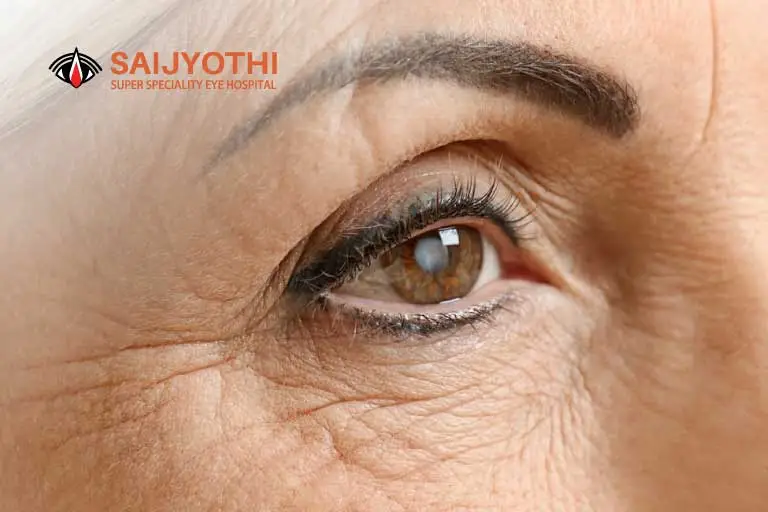 Can Cataracts Come Back After Surgery?