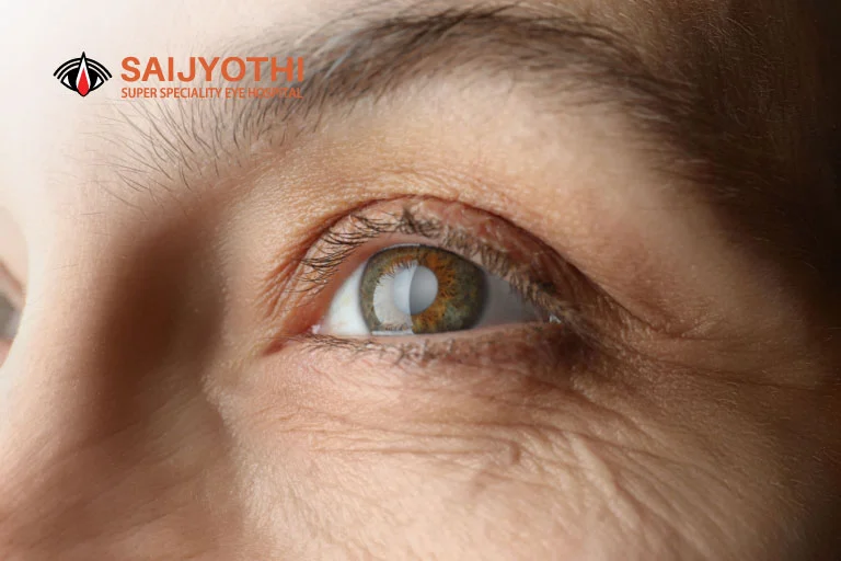 Cataract Eye Surgery with Glaucoma